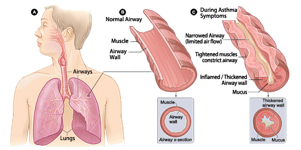 Asthma Attack Diagram